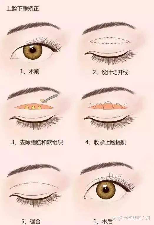 全新双眼皮技术重塑魅力双眼，科技革新美丽视界
